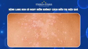 Bệnh lang ben do nấm Malassezia furfur gây ra