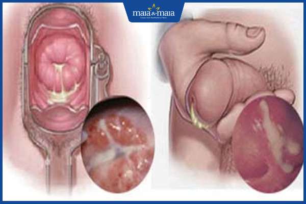 [TỔNG HỢP] Bệnh lậu và những thông tin cần biết về bệnh lậu