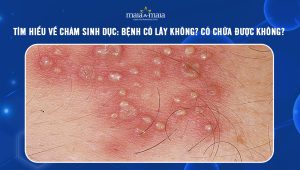 [TỔNG HỢP] Tìm hiểu về chàm sinh dục: Bệnh có lây không? Có chữa được không?