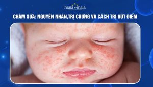  [TỔNG HỢP] Chàm sữa: Nguyên nhân, triệu chứng và cách trị dứt điểm chàm sữa