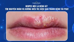 Herpes môi là bệnh gì? Tìm nguyên nhân và hướng điều trị hiệu quả tránh bệnh tái phát