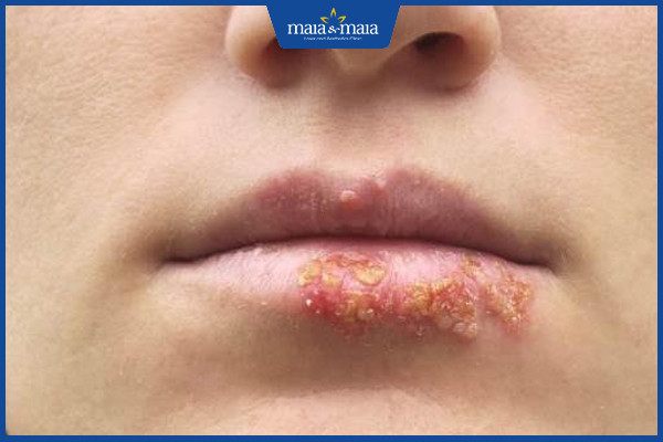 Herpes môi là bệnh gì? Tìm nguyên nhân và hướng điều trị hiệu quả tránh bệnh tái phát