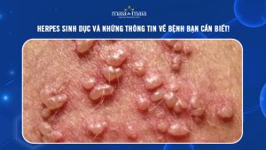 [TỔNG HỢP] Herpes sinh dục và những thông tin về bệnh bạn cần biết!