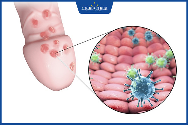 [TỔNG HỢP] Herpes sinh dục và những thông tin về bệnh bạn cần biết!