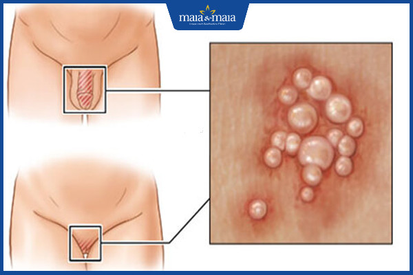 [TỔNG HỢP] Herpes sinh dục và những thông tin về bệnh bạn cần biết!