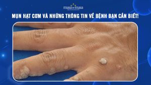 [TỔNG HỢP] Mụn hạt cơm và những thông tin về bệnh bạn cần biết!