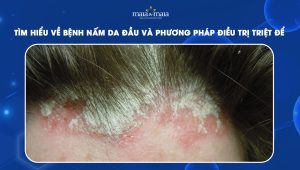 [TỔNG HỢP] Tìm hiểu về bệnh nấm da đầu và phương pháp điều trị triệt để