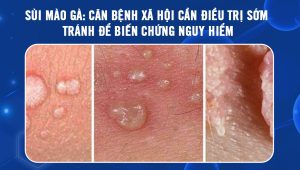 Bệnh sùi mào gà là căn bệnh xã hội có tỷ lệ lây nhiễm cao