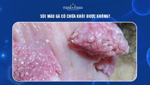 Sùi mào gà có chữa khỏi được không