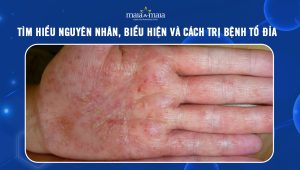 [TỔNG HỢP] Tìm hiểu nguyên nhân, biểu hiện và cách trị bệnh tổ đỉa