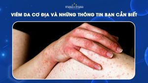 [TỔNG HỢP] Viêm da cơ địa và những thông tin bạn cần biết 