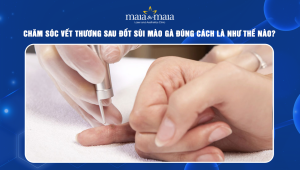 CHĂM SÓC VẾT THƯƠNG SAU ĐỐT SÙI MÀO GÀ ĐÚNG CÁCH LÀ NHƯ THẾ NÀO?