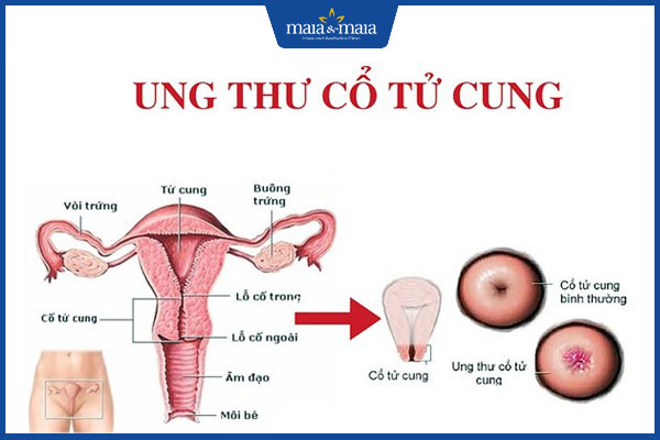 chẩn đoán sùi mào gà