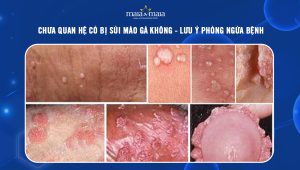 chưa quan hệ có bị sùi mào gà không