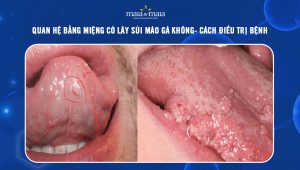 quan hệ bằng miệng có lây sùi mào gà không