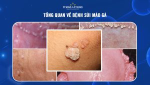 Tổng Quan Về Bệnh Sùi Mào Gà