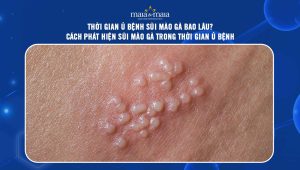 thời gian ủ bệnh sùi mào gà