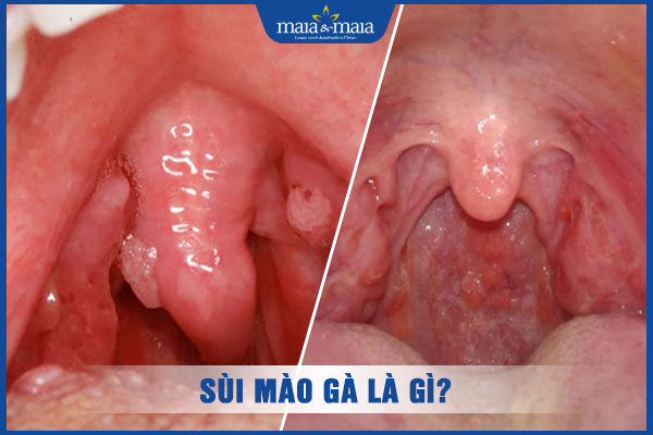 bệnh sùi mào gà ở họng