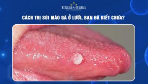 cách trị sùi mào gà ở lưỡi