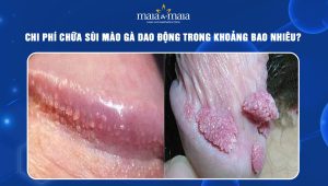 chi phí chữa sùi mào gà