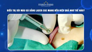 điều trị sùi mào gà bằng laser co2