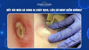 đốt sùi mào gà xong bị chảy dịch