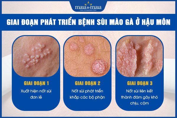 giai đoạn phát triển sùi mào gà ở hậu môn