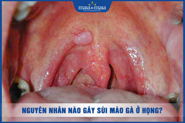 mắc sùi mào gà ở họng