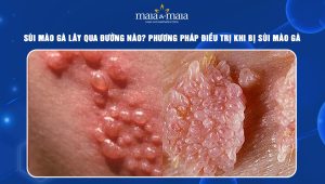 sùi mào gà lây qua đường nào