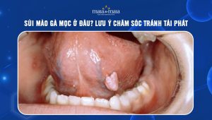 sùi mào gà mọc ở đâu