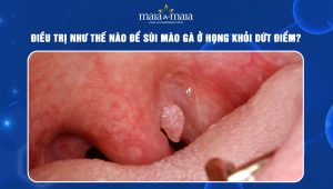 sùi mào gà ở họng