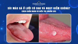 sùi mào gà ở lưỡi