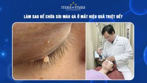 sùi mào gà ở mắt