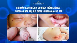 sùi mào gà ở trẻ em