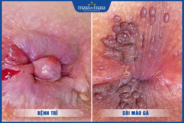 sùi mào gà và bệnh trĩ