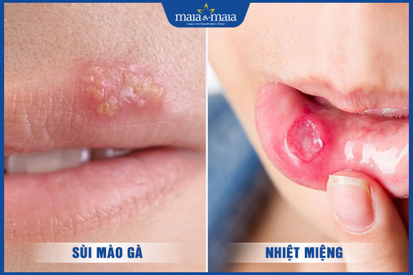 sùi mào gà và nhiệt miệng