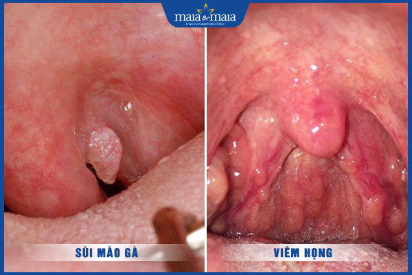 sùi mào gà và viêm họng