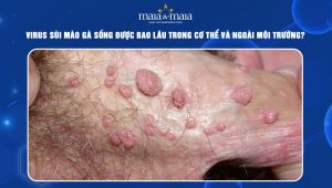 virus sùi mào gà sống được bao lâu