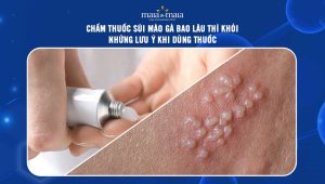 chấm thuốc sùi mào gà bao lâu thì khỏi