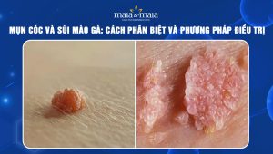 mụn cóc và sùi mào gà