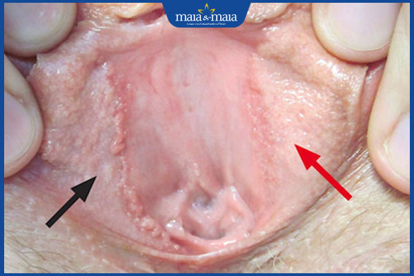 sùi mào gà ở âm đạo