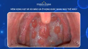 viêm họng hạt và sùi mào gà