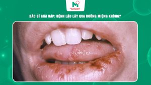 bệnh lậu lây qua đường miệng