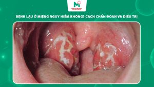 bệnh lậu ở miệng