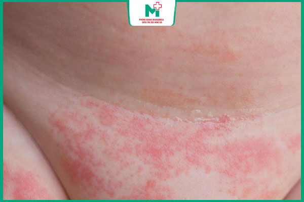 mẩn đỏ vùng kín