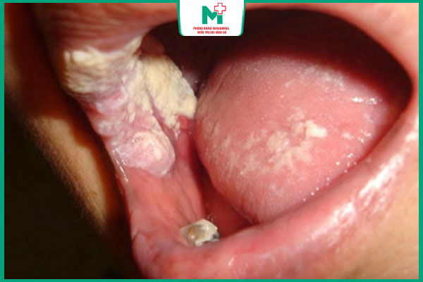 tìm hiểu bệnh lậu ở miệng