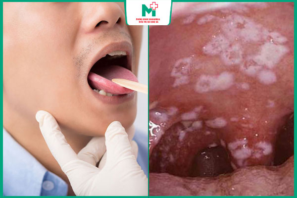 triệu chứng bệnh lậu ở miệng nam giới