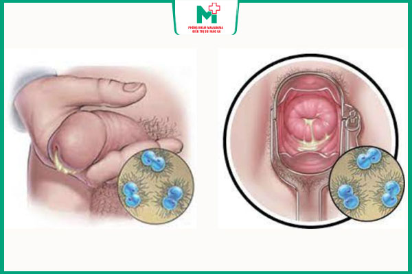 triệu chứng của bệnh lậu