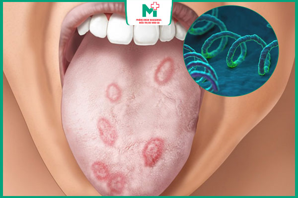 ăn uống lây giang mai