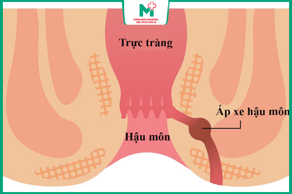 áp xe hậu môn